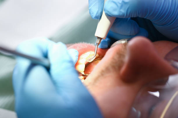 Best Emergency Tooth Extraction in Victoria, VA