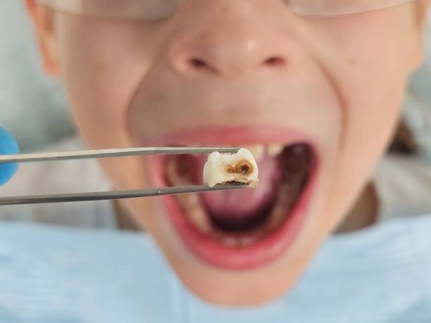 Best Emergency Tooth Extraction in Victoria, VA